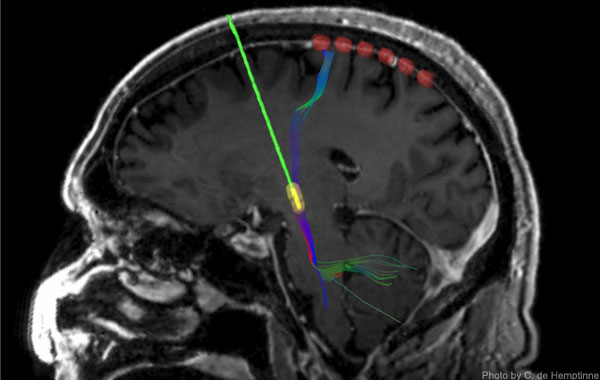 This CT image taken during surgery was superimposed on a preoperative MRI of one patient's brain. It shows a strip of detectors (red dots) used to record cortical activity and a deep-brain stimulation electrode (green cylinder with yellow tip). The multi-color traces represent the fibers connecting the two.